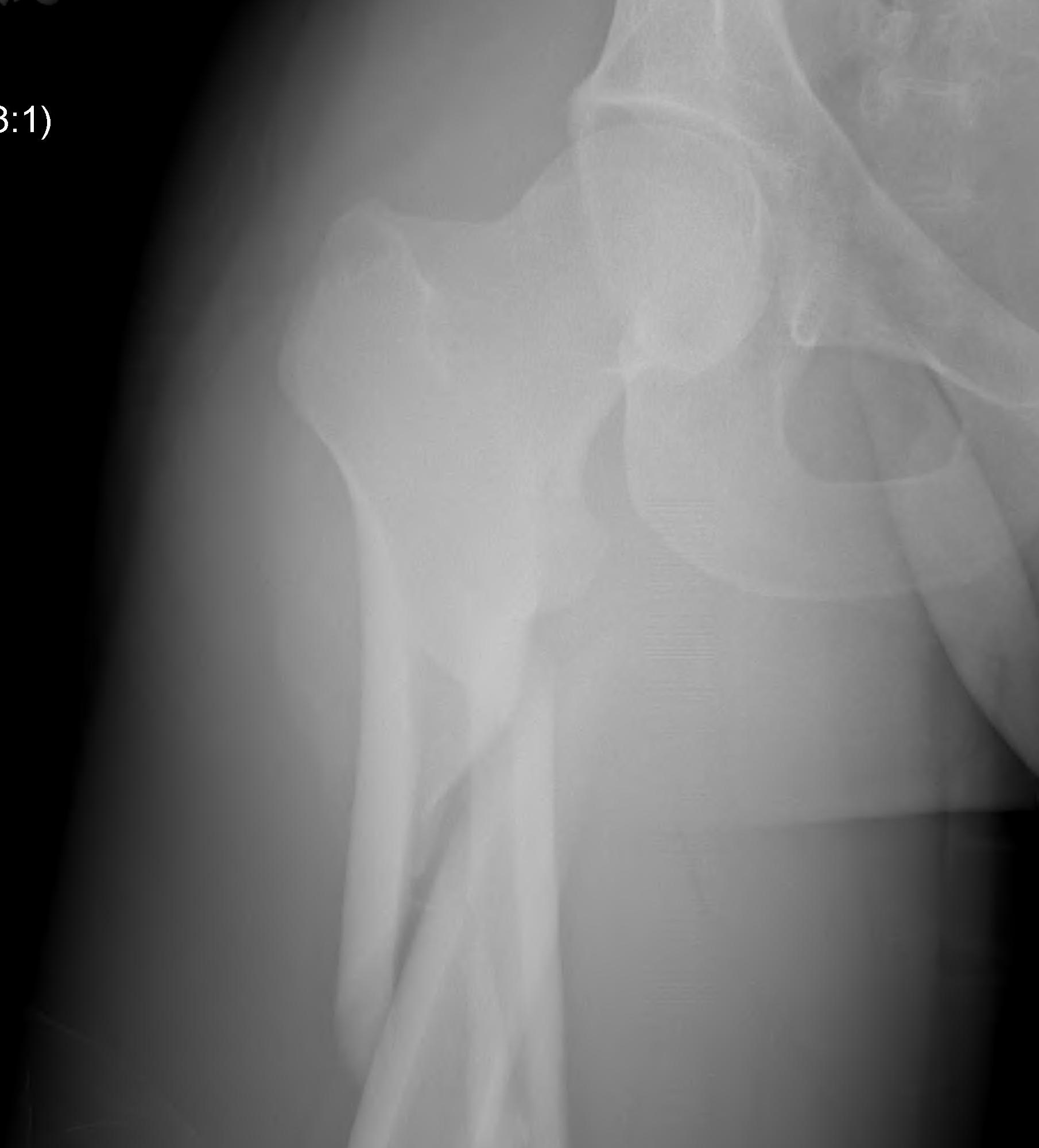 Subtrochanteric Fracture Long Spiral